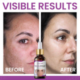 Melanix Advanced Brightening Serum | Dark Spot Corrector & Skin Tone Repair | Fade Pigmentation & Boost Radiance (30ml)